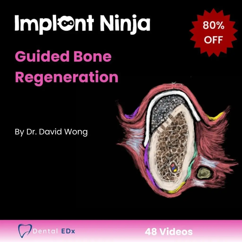 Ninja Guided Bone Regeneration